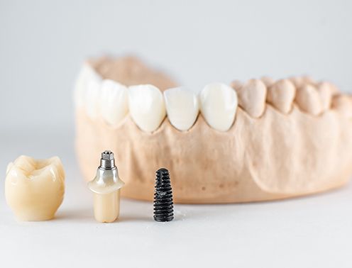 Primer plano sobre el modelo de yeso de mandíbula artificial e implante dental sobre el fondo blanco. Concepto de prótesis e implantación en odontología.