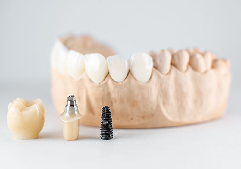 Primer plano sobre el modelo de yeso de mandíbula artificial e implante dental sobre el fondo blanco. Concepto de prótesis e implantación en odontología.