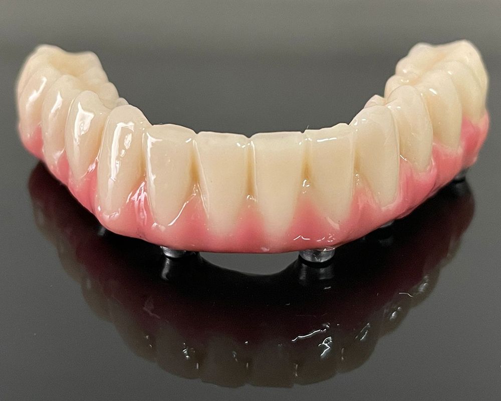 Prótesis dental para atornillar a implantes.